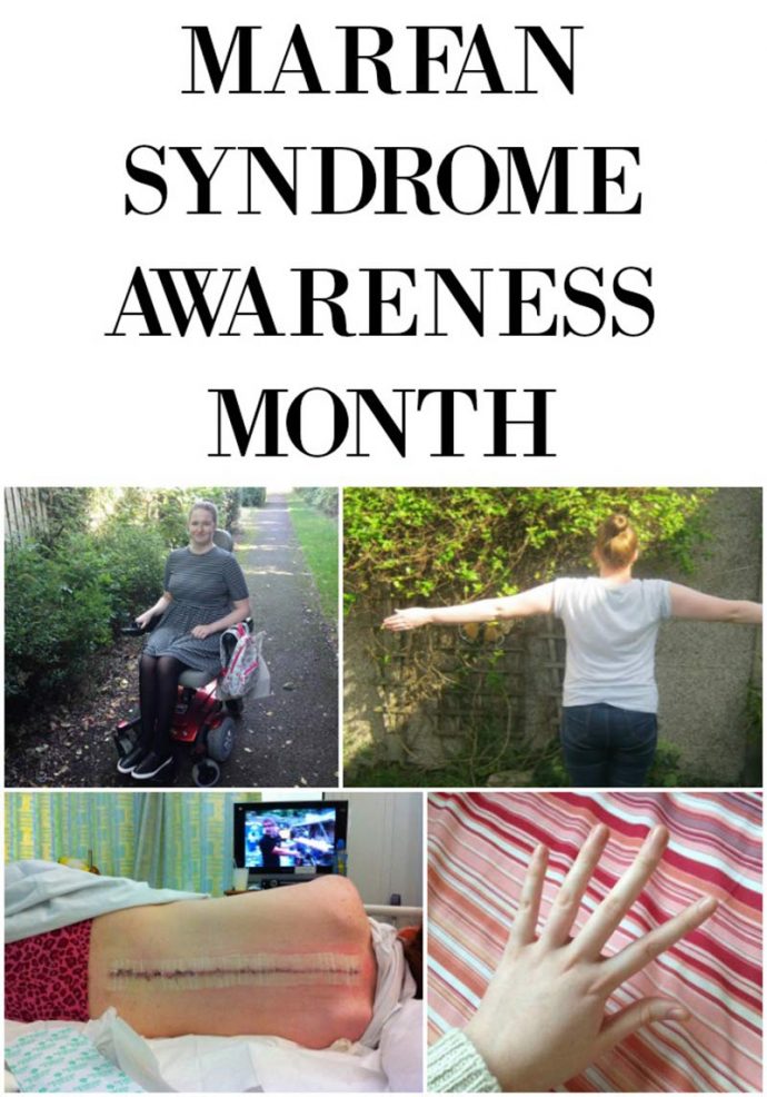 Do you know what Marfan Syndrome is? Click to learn more about Marfan as part of Marfan Awareness month. Pin to save for later.